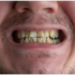 Yellow Teeth Causes
