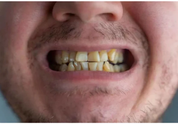 Yellow Teeth Causes