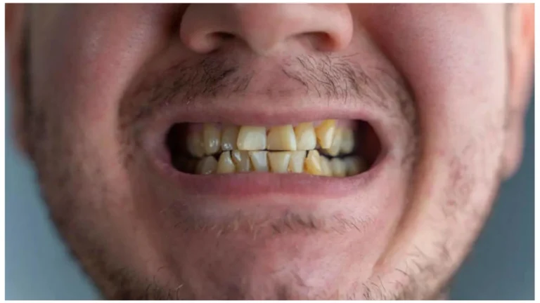 Yellow Teeth Causes