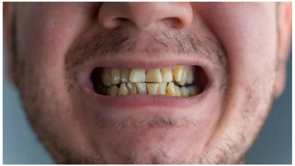 Yellow Teeth Causes